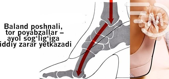 Baland poshnali, tor poyabzallar – ayol sog’lig’iga jiddiy zarar yetkazadi